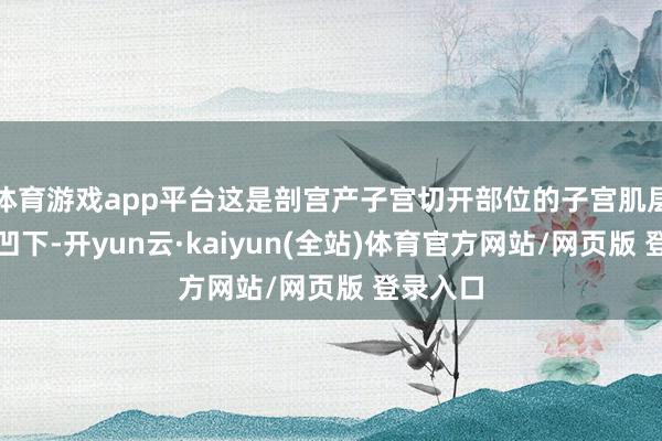 体育游戏app平台这是剖宫产子宫切开部位的子宫肌层变薄、凹下-开yun云·kaiyun(全站)体育官方网站/网页版 登录入口